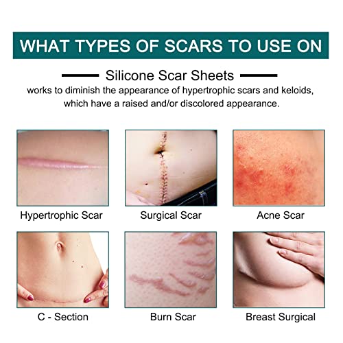 Silicone Scar Sheets (1.6” x 120” Roll-3M), Silicone Scar Tape Roll, Scar Silicone Strips, Reusable, Professional Scar Removal Sheets for C-Section, Surgery, Burn, Keloid, Acne et