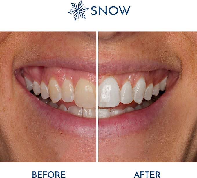 SNOW Teeth Whitening Kit with LED Light, Complete at-Home Whitening System - Zecoya